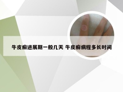 牛皮癣进展期一般几天 牛皮癣病程多长时间