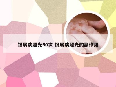 银屑病照光50次 银屑病照光的副作用