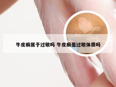 牛皮癣属于过敏吗 牛皮癣是过敏体质吗