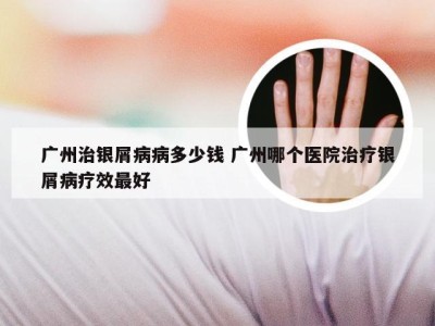 广州治银屑病病多少钱 广州哪个医院治疗银屑病疗效最好