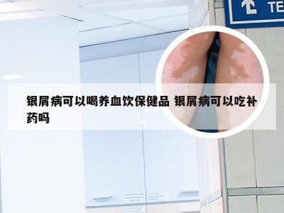 银屑病可以喝养血饮保健品 银屑病可以吃补药吗