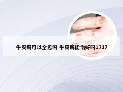牛皮癣可以全愈吗 牛皮癣能治好吗1717
