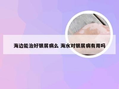海边能治好银屑病么 海水对银屑病有用吗