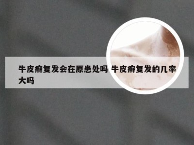 牛皮癣复发会在原患处吗 牛皮癣复发的几率大吗