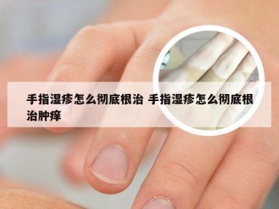 手指湿疹怎么彻底根治 手指湿疹怎么彻底根治肿痒