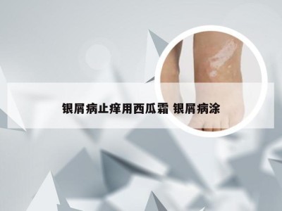 银屑病止痒用西瓜霜 银屑病涂