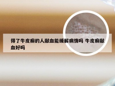 得了牛皮癣的人献血能缓解病情吗 牛皮癣献血好吗