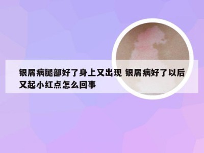 银屑病腿部好了身上又出现 银屑病好了以后又起小红点怎么回事