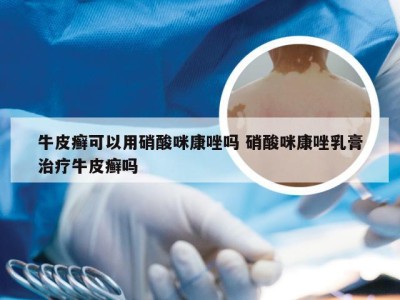 牛皮癣可以用硝酸咪康唑吗 硝酸咪康唑乳膏治疗牛皮癣吗