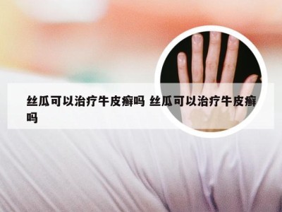 丝瓜可以治疗牛皮癣吗 丝瓜可以治疗牛皮癣吗