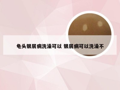 龟头银屑病洗澡可以 银屑病可以洗澡不