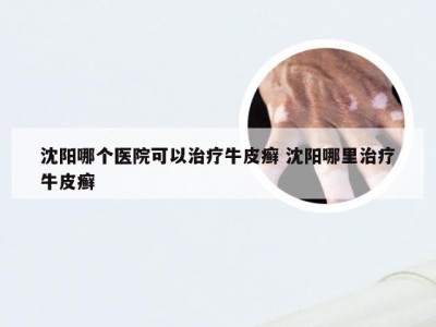 沈阳哪个医院可以治疗牛皮癣 沈阳哪里治疗牛皮癣