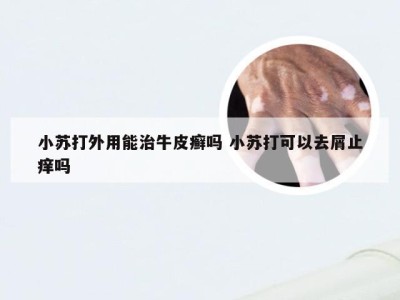 小苏打外用能治牛皮癣吗 小苏打可以去屑止痒吗