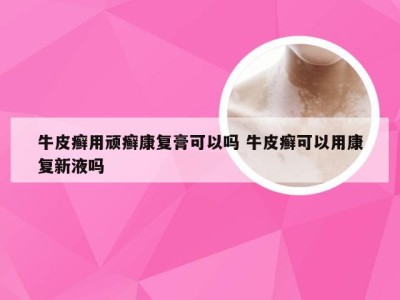 牛皮癣用顽癣康复膏可以吗 牛皮癣可以用康复新液吗