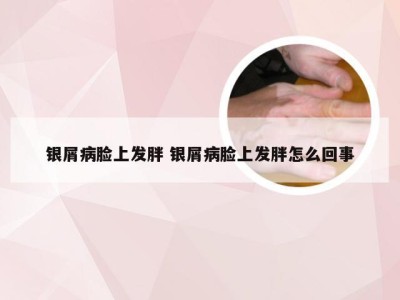 银屑病脸上发胖 银屑病脸上发胖怎么回事