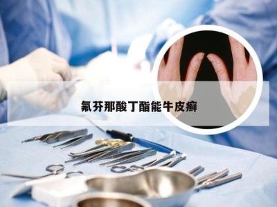 氟芬那酸丁酯能牛皮癣