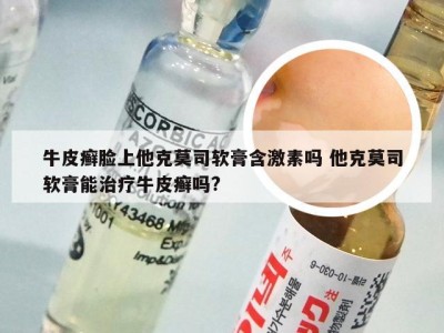牛皮癣脸上他克莫司软膏含激素吗 他克莫司软膏能治疗牛皮癣吗?