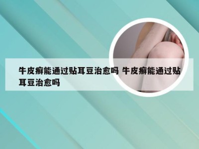 牛皮癣能通过贴耳豆治愈吗 牛皮癣能通过贴耳豆治愈吗
