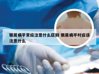 银屑病平常应注意什么区别 银屑病平时应该注意什么