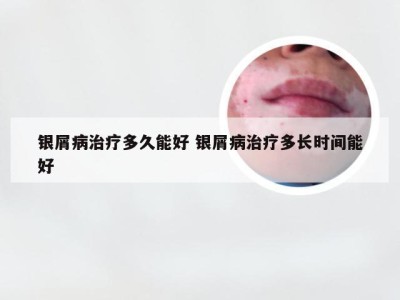 银屑病治疗多久能好 银屑病治疗多长时间能好