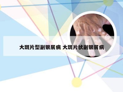 大斑片型副银屑病 大斑片状副银屑病
