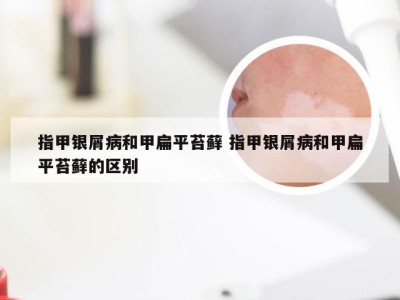 指甲银屑病和甲扁平苔藓 指甲银屑病和甲扁平苔藓的区别