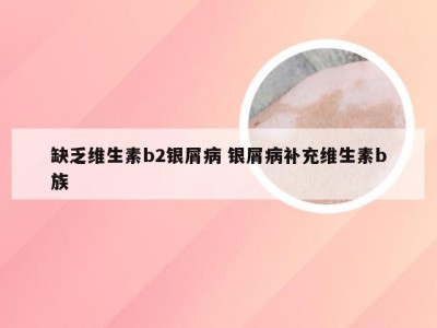 缺乏维生素b2银屑病 银屑病补充维生素b族