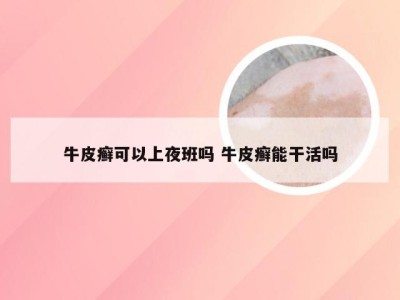 牛皮癣可以上夜班吗 牛皮癣能干活吗