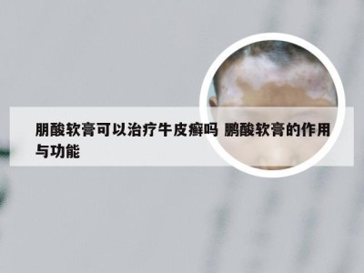 朋酸软膏可以治疗牛皮癣吗 鹏酸软膏的作用与功能