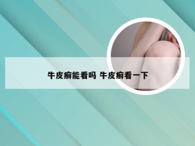 牛皮癣能看吗 牛皮癣看一下