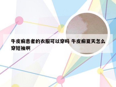 牛皮癣患者的衣服可以穿吗 牛皮癣夏天怎么穿短袖啊