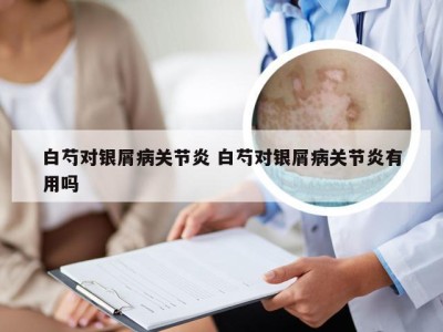 白芍对银屑病关节炎 白芍对银屑病关节炎有用吗