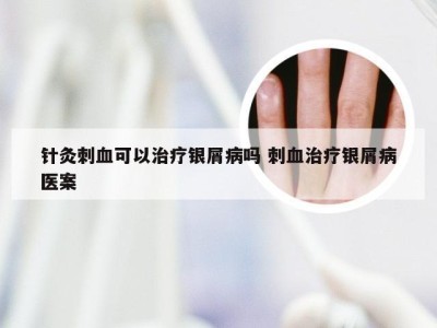 针灸刺血可以治疗银屑病吗 刺血治疗银屑病医案