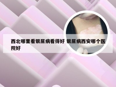 西北哪里看银屑病看得好 银屑病西安哪个医院好