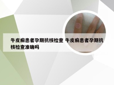 牛皮癣患者孕期抗核检查 牛皮癣患者孕期抗核检查准确吗