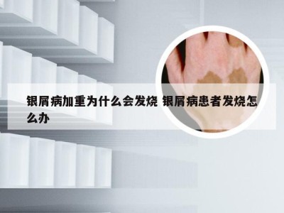 银屑病加重为什么会发烧 银屑病患者发烧怎么办