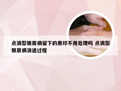 点滴型银屑病留下的黑印不用处理吗 点滴型银屑病消退过程