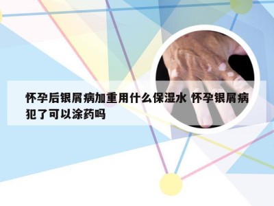 怀孕后银屑病加重用什么保湿水 怀孕银屑病犯了可以涂药吗