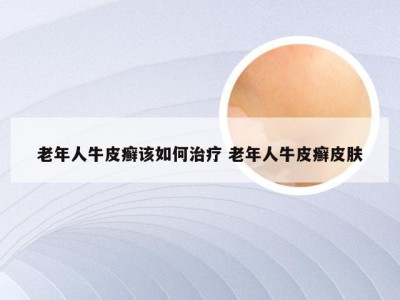 老年人牛皮癣该如何治疗 老年人牛皮癣皮肤