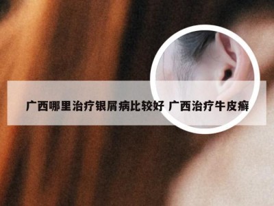 广西哪里治疗银屑病比较好 广西治疗牛皮癣
