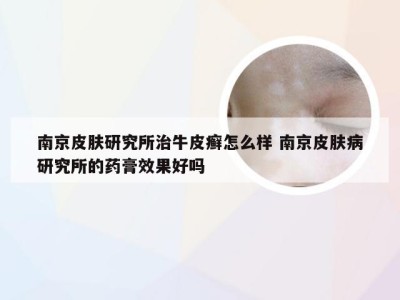 南京皮肤研究所治牛皮癣怎么样 南京皮肤病研究所的药膏效果好吗
