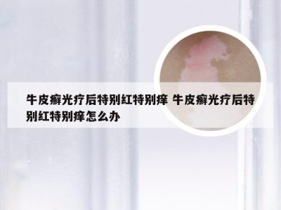牛皮癣光疗后特别红特别痒 牛皮癣光疗后特别红特别痒怎么办