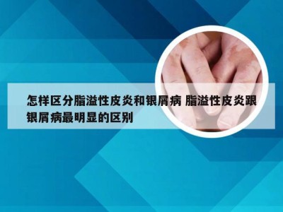 怎样区分脂溢性皮炎和银屑病 脂溢性皮炎跟银屑病最明显的区别