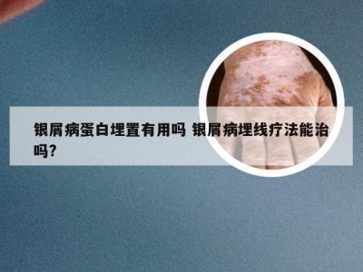 银屑病蛋白埋置有用吗 银屑病埋线疗法能治吗?