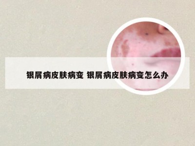 银屑病皮肤病变 银屑病皮肤病变怎么办