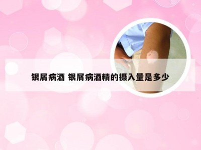 银屑病酒 银屑病酒精的摄入量是多少