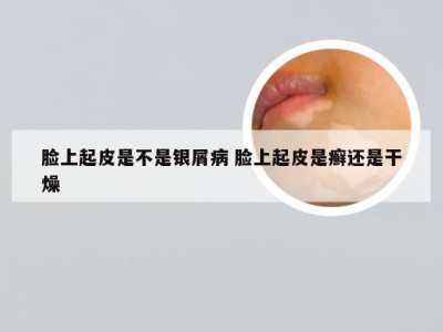 脸上起皮是不是银屑病 脸上起皮是癣还是干燥