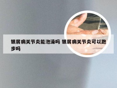 银屑病关节炎能泡澡吗 银屑病关节炎可以跑步吗
