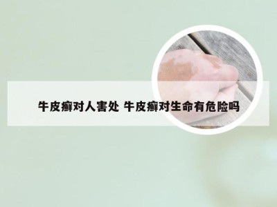 牛皮癣对人害处 牛皮癣对生命有危险吗