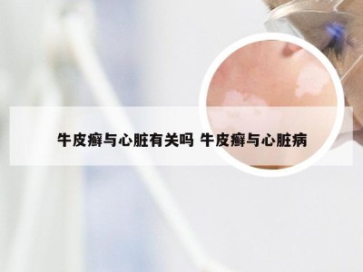 牛皮癣与心脏有关吗 牛皮癣与心脏病